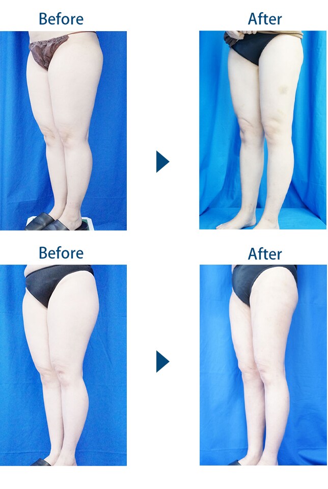 超お特 最新機械で特別価格に挑戦 神奈 脂肪吸引モニター募集 美容整形 美容外科の湘南美容クリニック