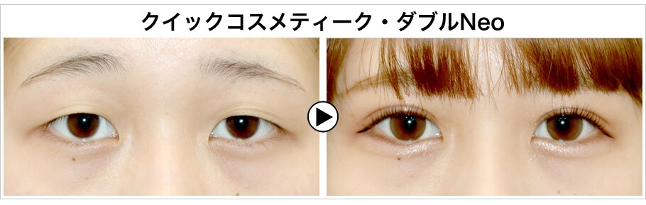 Sbc公式二重術オススメdr 選出 豊 二重 二重整形モニター募集 美容整形 美容外科の湘南美容クリニック Sbc公式二重術オススメdr 選出 豊 二重 二重整形モニター募集 美容整形 美容外科の湘南美容クリニック