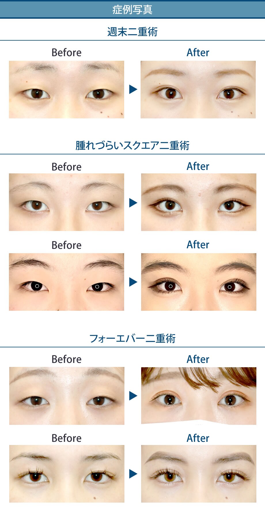 丁寧なカウンセリングと確かな技術 大人気 二重 二重整形モニター募集 美容整形 美容外科の湘南美容クリニック 丁寧なカウンセリングと確かな技術 大人気 二重 二重整形モニター募集 美容整形 美容外科の湘南美容クリニック