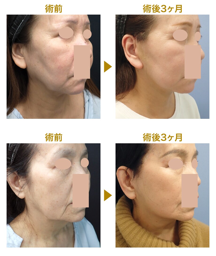 切るフェイスリフト 4 50代 たるみ 若返りモニター募集 美容整形 美容外科の湘南美容クリニック