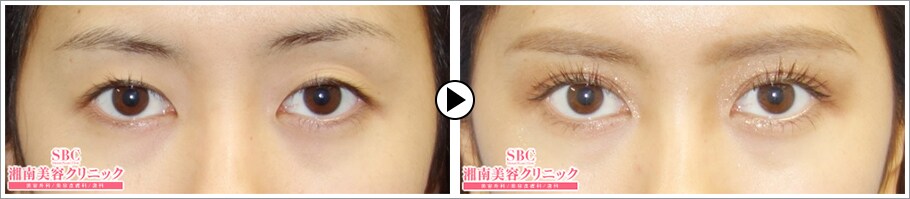 埋没法二重術 極限まで腫れづらい埋没法 二重 二重整形モニター募集 美容整形 美容外科の湘南美容クリニック
