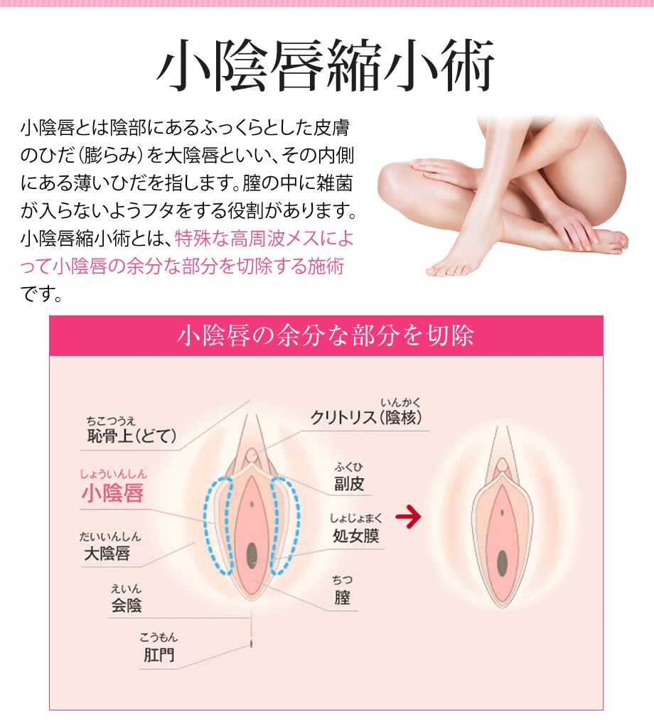 婦人科形成 人には相談しにくいデリケー 婦人科形成モニター募集 美容整形 美容外科の湘南美容クリニック