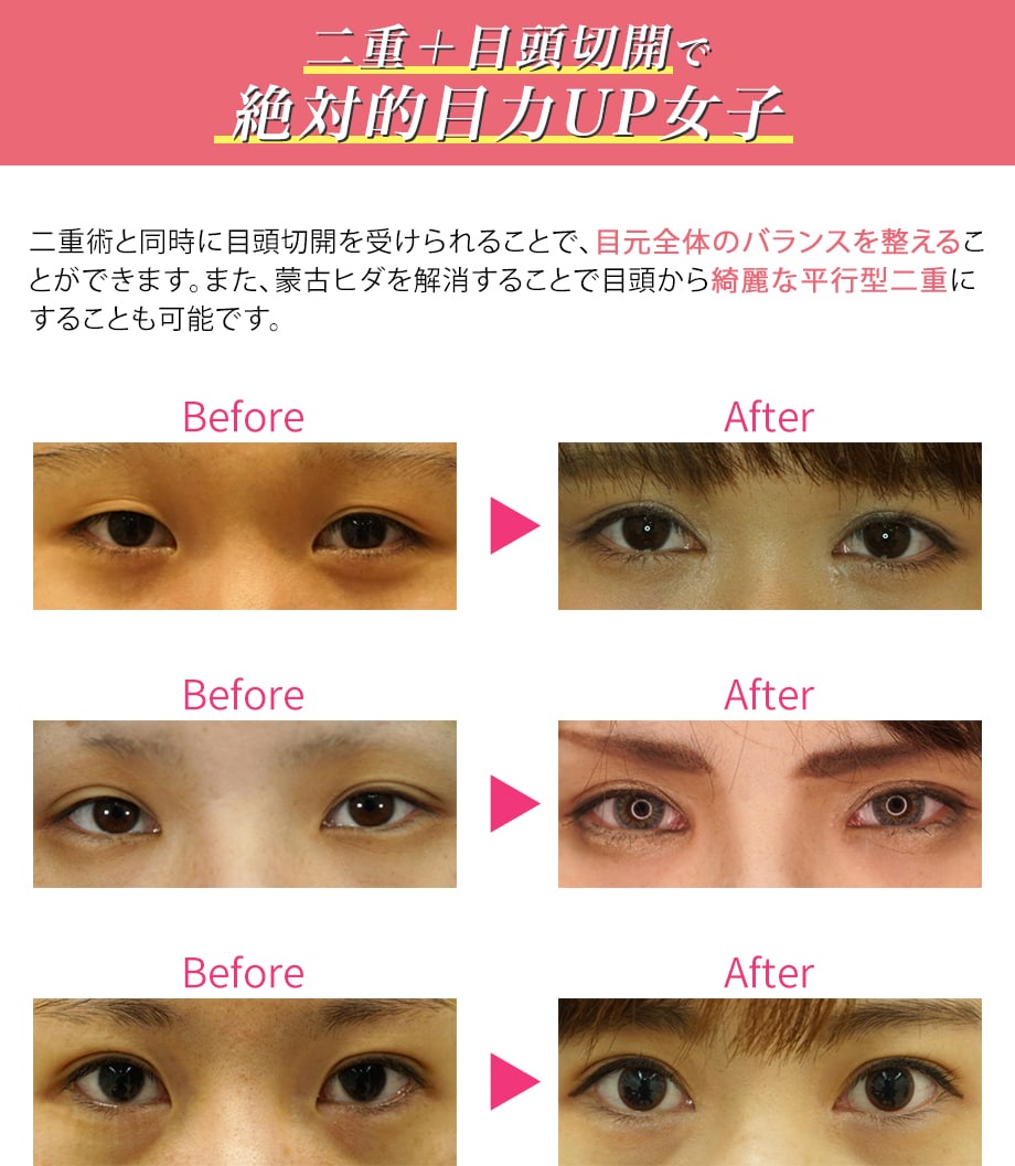 デカ 目 整形 Gruffudd Paderau デカ 目 整形 Gruffudd Paderau