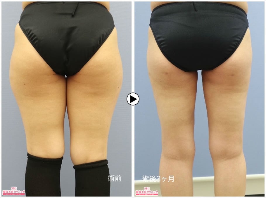 人気TOP人気TOP湘南美容外科☆脂肪吸引 エクササイズ用品