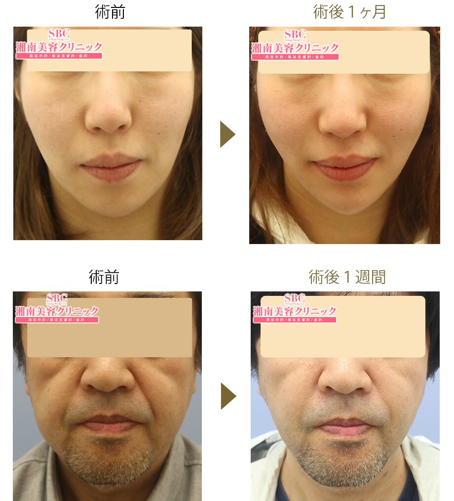 糸リフト 札幌院梶山院長のモニター S 若返りモニター募集 美容整形 美容外科の湘南美容クリニック 糸リフト 札幌院梶山院長のモニター S 若返りモニター募集 美容整形 美容外科の湘南美容クリニック