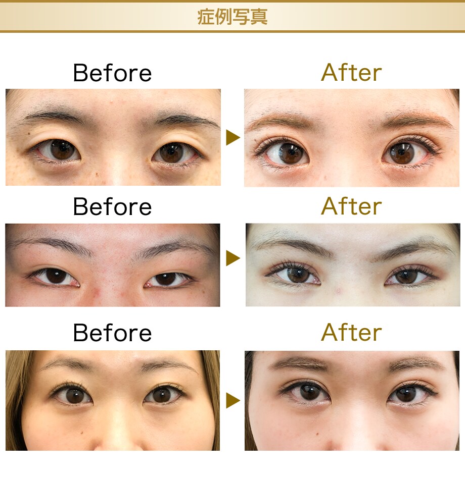 フォーエバー二重術 美容外科学会認定専 二重 二重整形モニター募集 美容整形 美容外科の湘南美容クリニック フォーエバー二重術 美容外科学会認定専 二重 二重整形モニター募集 美容整形 美容外科の湘南美容クリニック