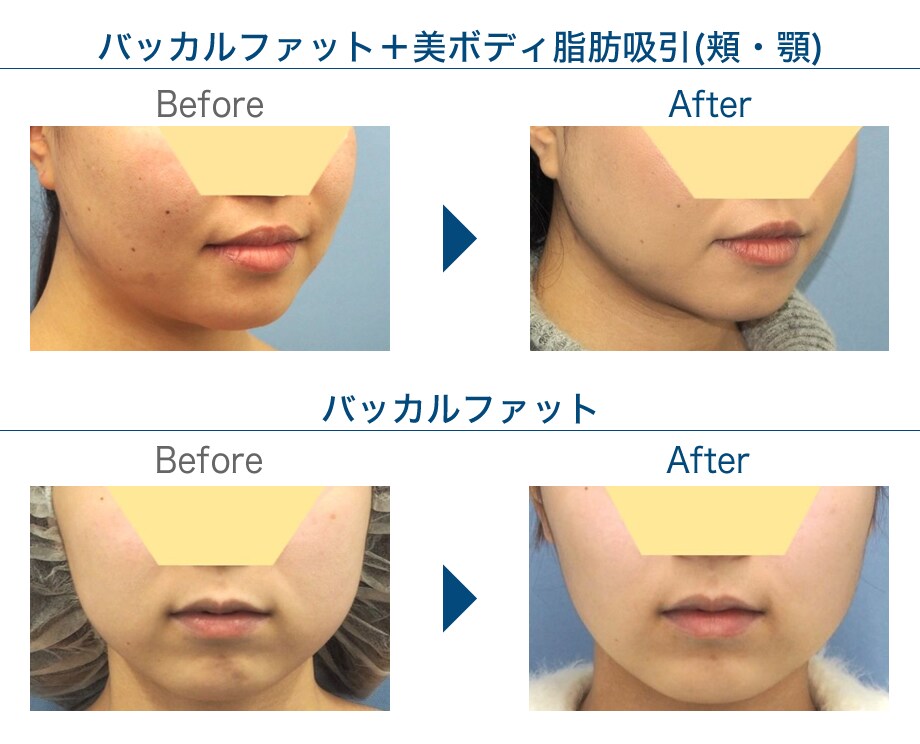 小顔になりたい方必見 効果 フェイスラインモニター募集 美容整形 美容外科の湘南美容クリニック 小顔になりたい方必見 効果 フェイスラインモニター募集 美容整形 美容外科の湘南美容クリニック