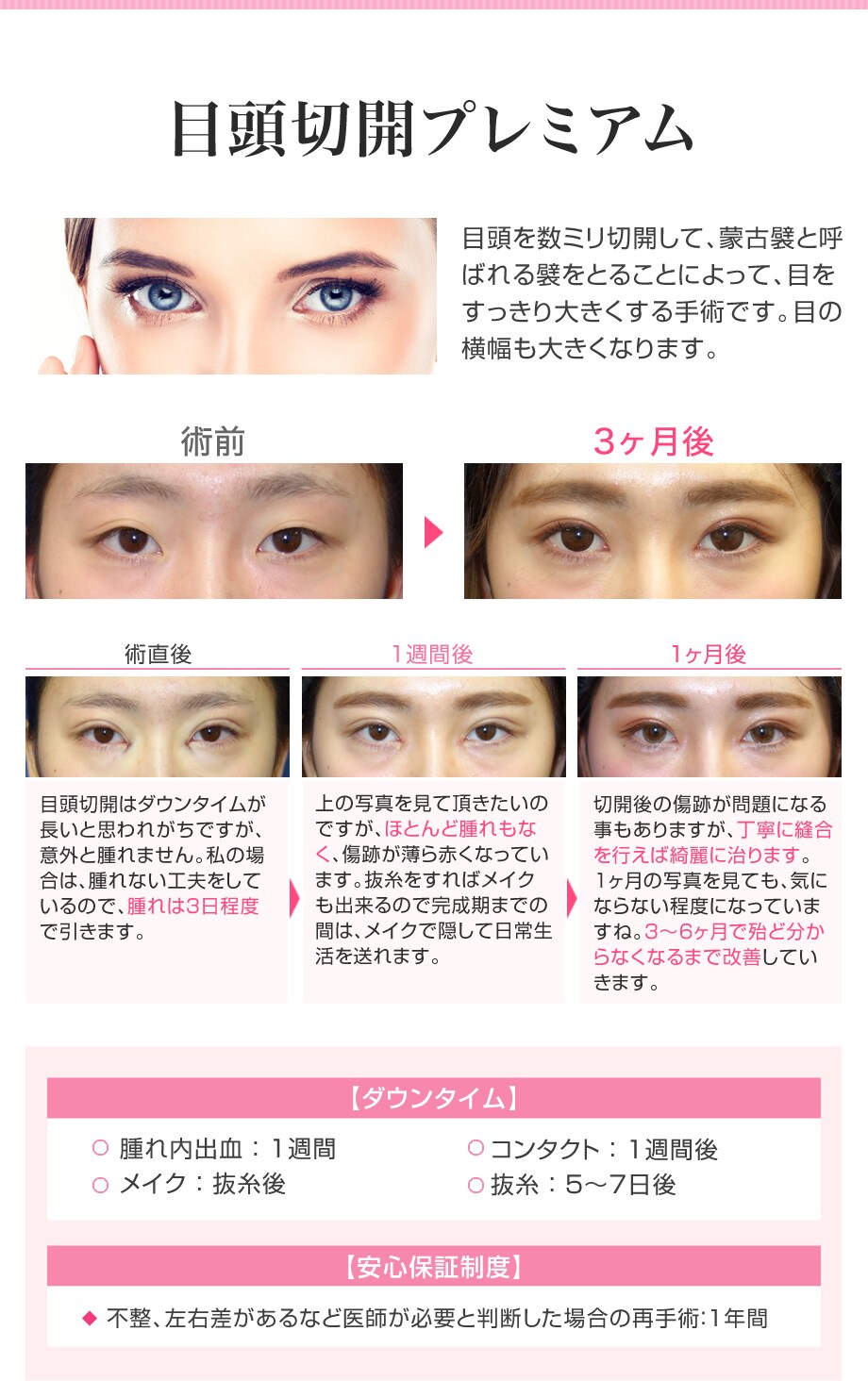 Md式スタート 目頭切開 切開法二重術で 二重 二重整形モニター募集 美容整形 美容外科の湘南美容クリニック