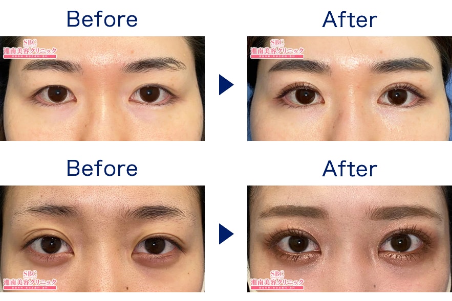 池袋西口院 似合わせ埋没二重術 当 二重 二重整形モニター募集 美容整形 美容外科の湘南美容クリニック