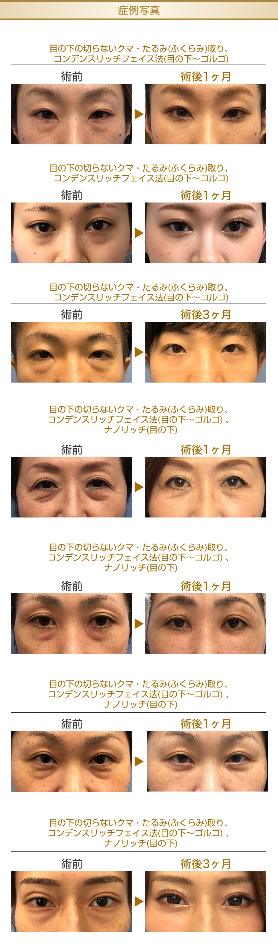 クマ 取り クマ 取り