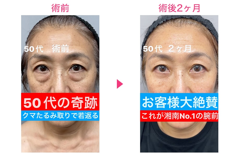 before after
