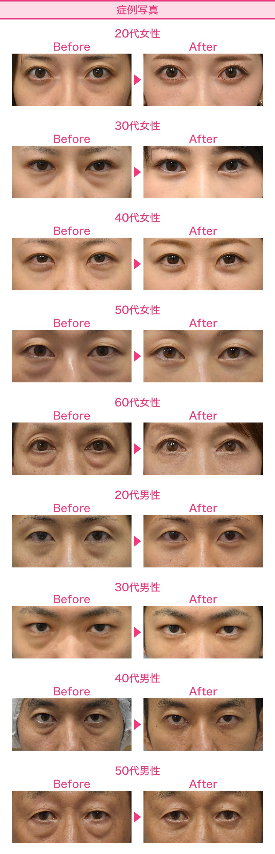 before after