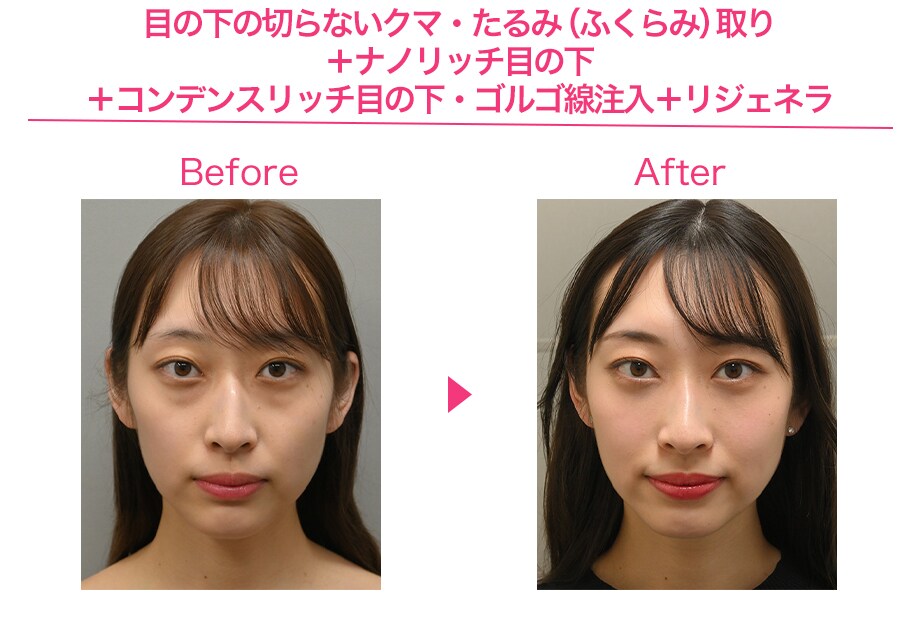 before after
