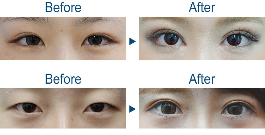 なりたい目元を半永久的に 二重整形術で 二重 二重整形モニター募集 美容整形 美容外科の湘南美容クリニック