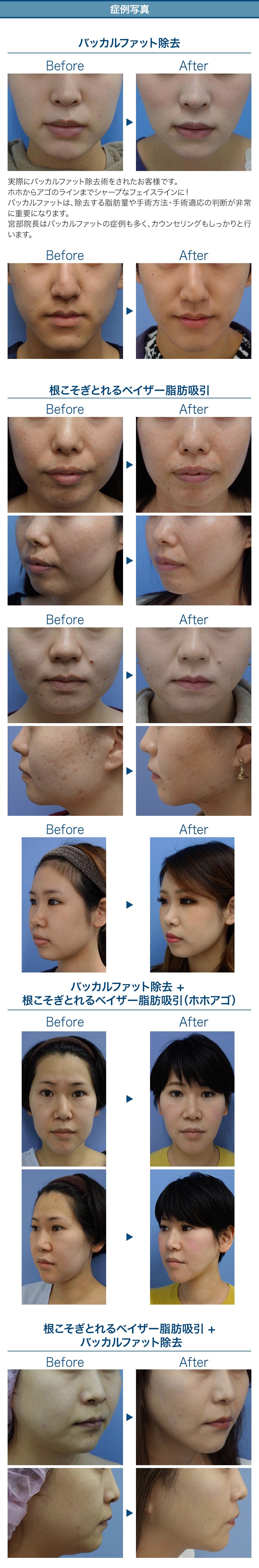 シャープなフェイスライン 脂肪吸引で理 フェイスラインモニター募集 美容整形 美容外科の湘南美容クリニック