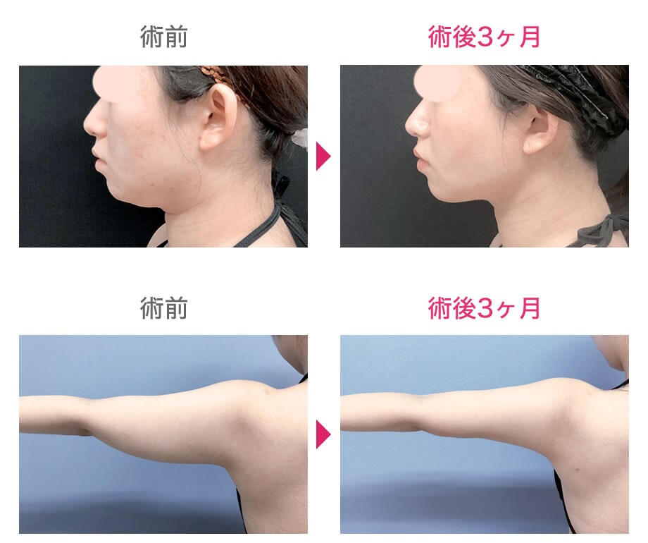 痩せにくい 二の腕 や気になる 顔 太 脂肪吸引モニター募集 美容整形 美容外科の湘南美容クリニック