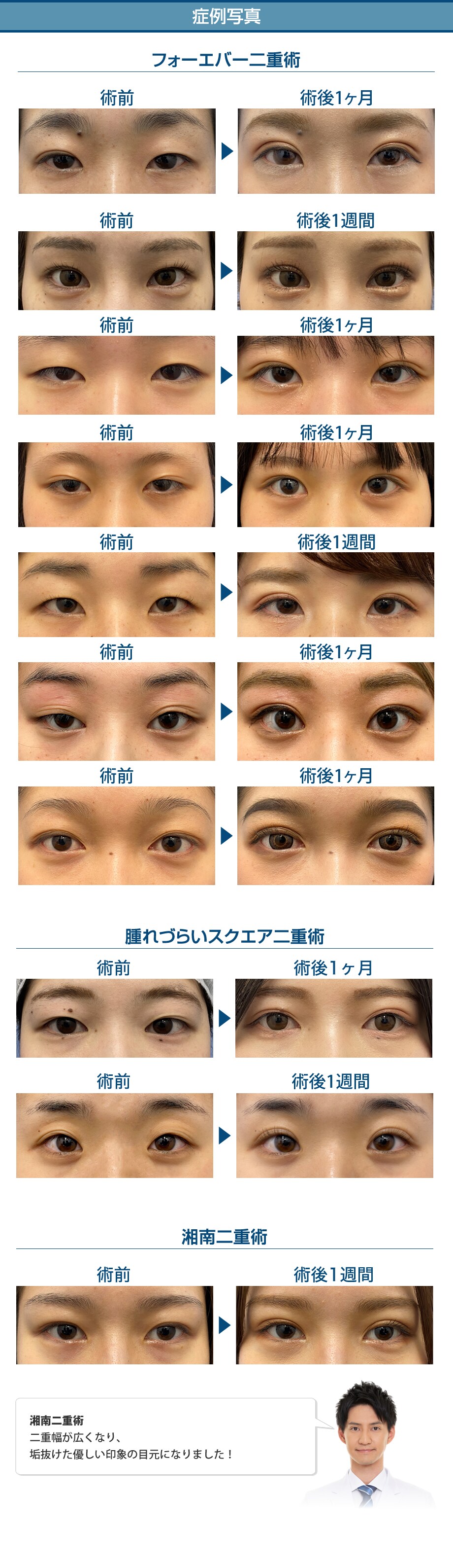 dr 三浦の銀座クオリティ二重術 ご予 二重 二重整形モニター募集 美容整形 美容外科の湘南美容クリニック dr 三浦の銀座クオリティ二重術 ご予 二重 二重整形モニター募集 美容整形 美容外科の湘南美容クリニック