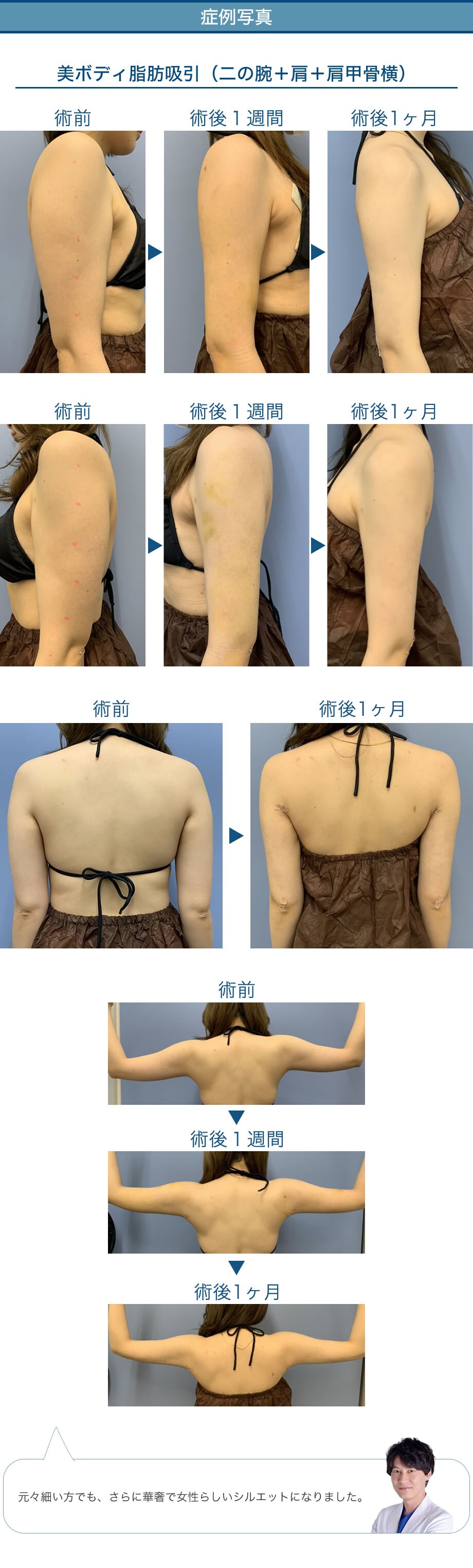 徹底的にこだわる二の腕脂肪吸引 モニタ 脂肪吸引モニター募集 美容整形 美容外科の湘南美容クリニック 徹底的にこだわる二の腕脂肪吸引 モニタ 脂肪吸引モニター募集 美容整形 美容外科の湘南美容クリニック