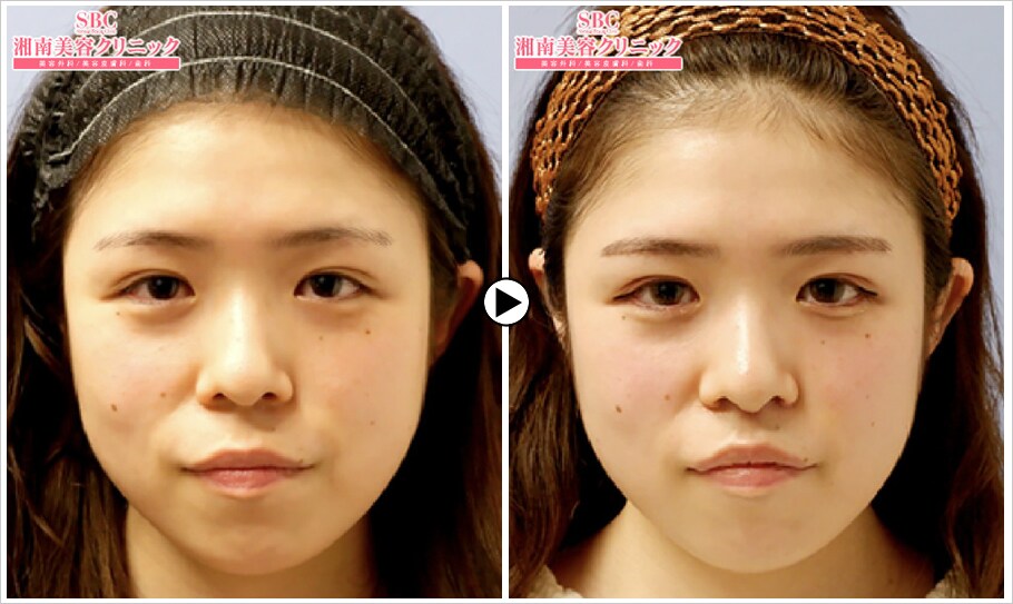 可愛い子は人中が短い 大流行中の人 その他の手術モニター募集 美容整形 美容外科の湘南美容クリニック 可愛い子は人中が短い 大流行中の人 その他の手術モニター募集 美容整形 美容外科の湘南美容クリニック