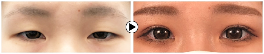 元大手美容クリニック副統括院長による緻密 二重 二重整形モニター募集 美容整形 美容外科の湘南美容クリニック