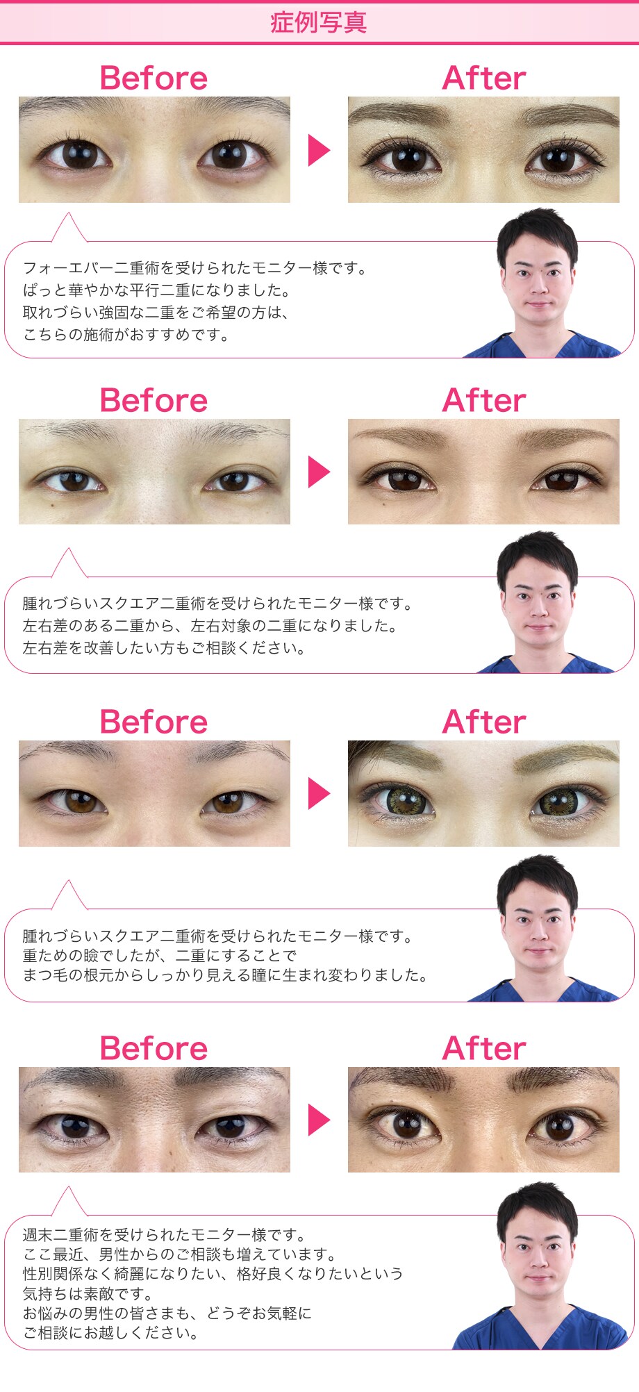 フォーエバー二重術 スクエア二重術 週末 二重 二重整形モニター募集 美容整形 美容外科の湘南美容クリニック フォーエバー二重術 スクエア二重術 週末 二重 二重整形モニター募集 美容整形 美容外科の湘南美容クリニック