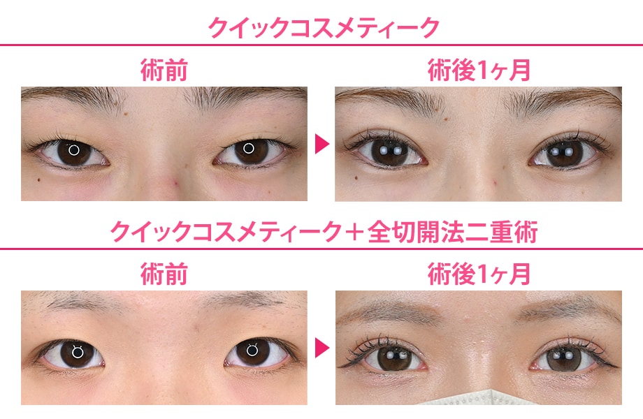 before-after