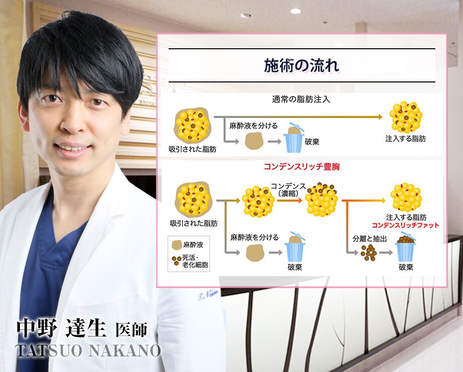 脂肪注入豊胸 アキーセル併用 ベイザ 豊胸 バストの修正モニター募集 美容整形 美容外科の湘南美容クリニック