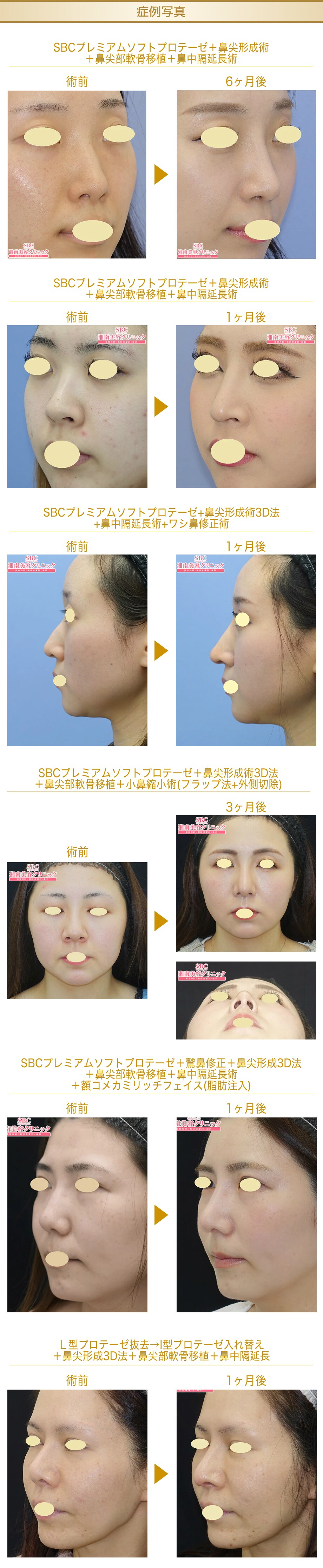 Sbc内全ドクターの中で唯一 3年半連続 鼻整形モニター募集 美容整形 美容外科の湘南美容クリニック Sbc内全ドクターの中で唯一 3年半連続 鼻整形モニター募集 美容整形 美容外科の湘南美容クリニック