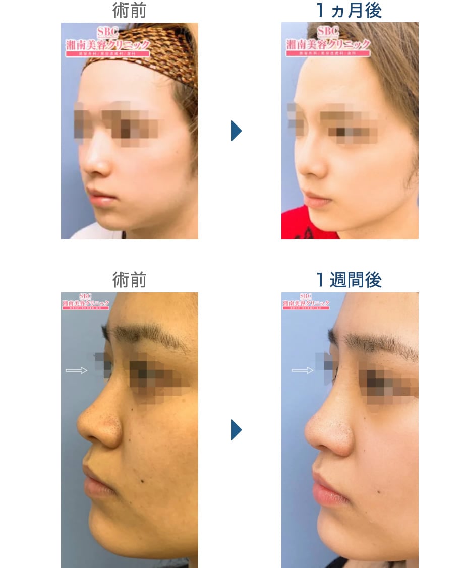 鼻整形 近江dr におまかせください 鼻整形モニター募集 美容整形 美容外科の湘南美容クリニック