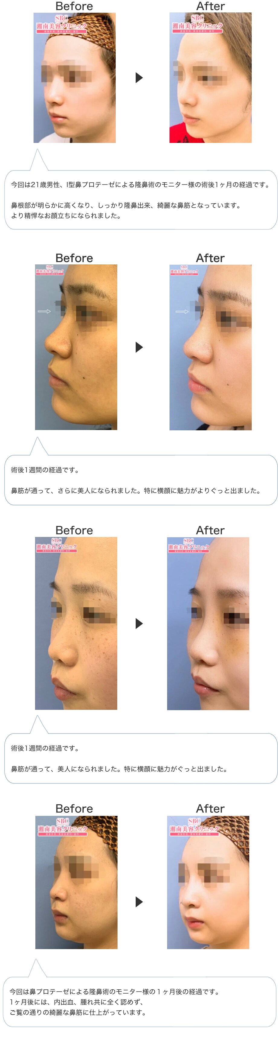 鼻プロテーゼ 近江dr におまかせくだ 鼻整形モニター募集 美容整形 美容外科の湘南美容クリニック