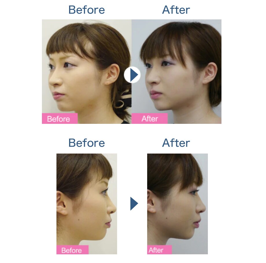 当日からメイク可能 切らない若返り お肌 若返りモニター募集 美容整形 美容外科の湘南美容クリニック