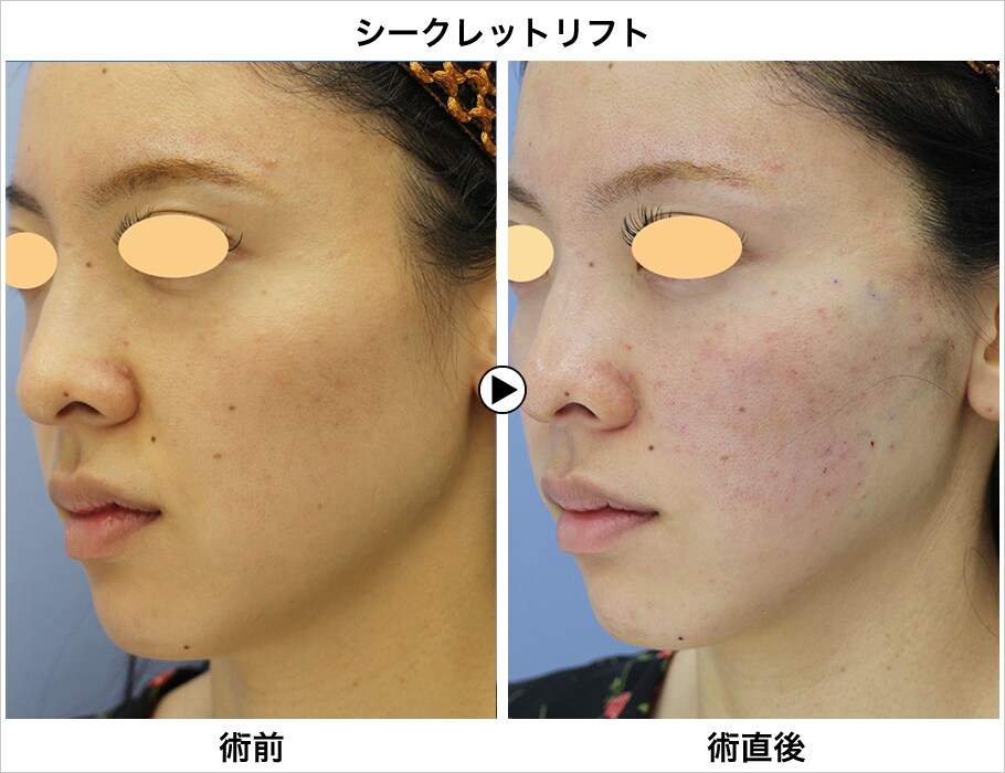 今がチャンス 口コミでも大人気な野口医師 若返りモニター募集 美容整形 美容外科の湘南美容クリニック 今がチャンス 口コミでも大人気な野口医師 若返りモニター募集 美容整形 美容外科の湘南美容クリニック