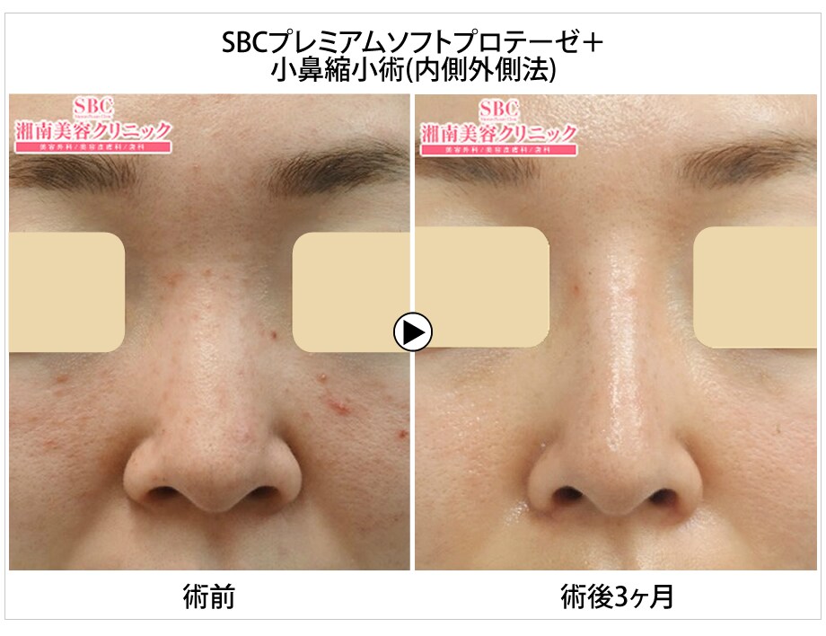 美容外科専門医 慶應医学部卒のベテラ 鼻整形モニター募集 美容整形 美容外科の湘南美容クリニック