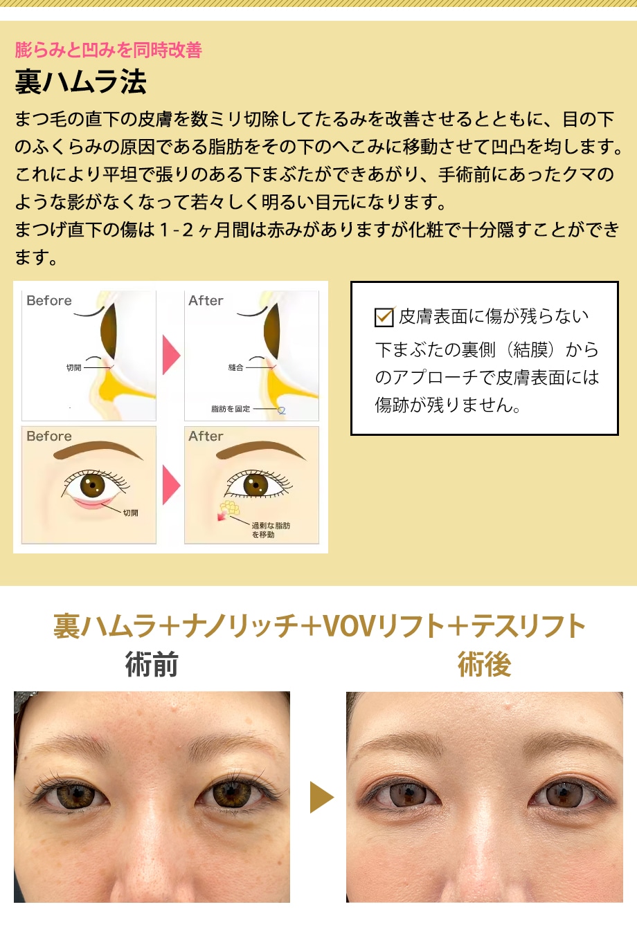 裏ハムラ