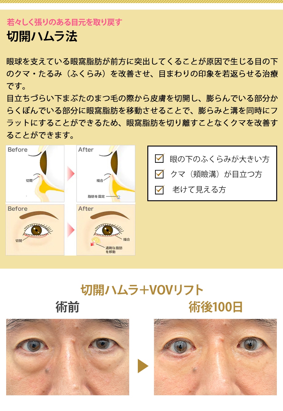 切開ハムラ