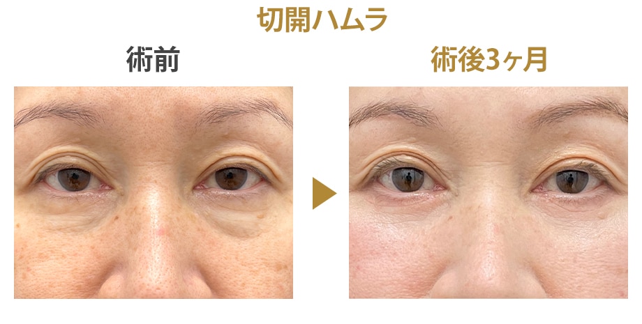 切開ハムラ