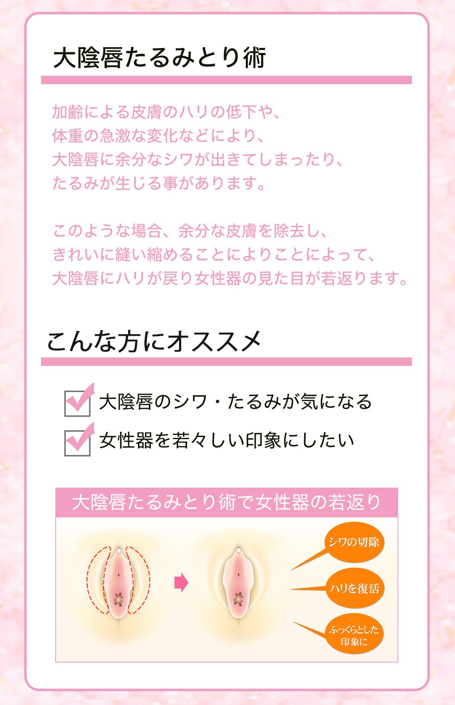 大陰唇たるみとり術