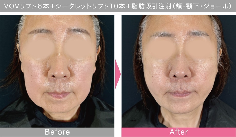 症例写真