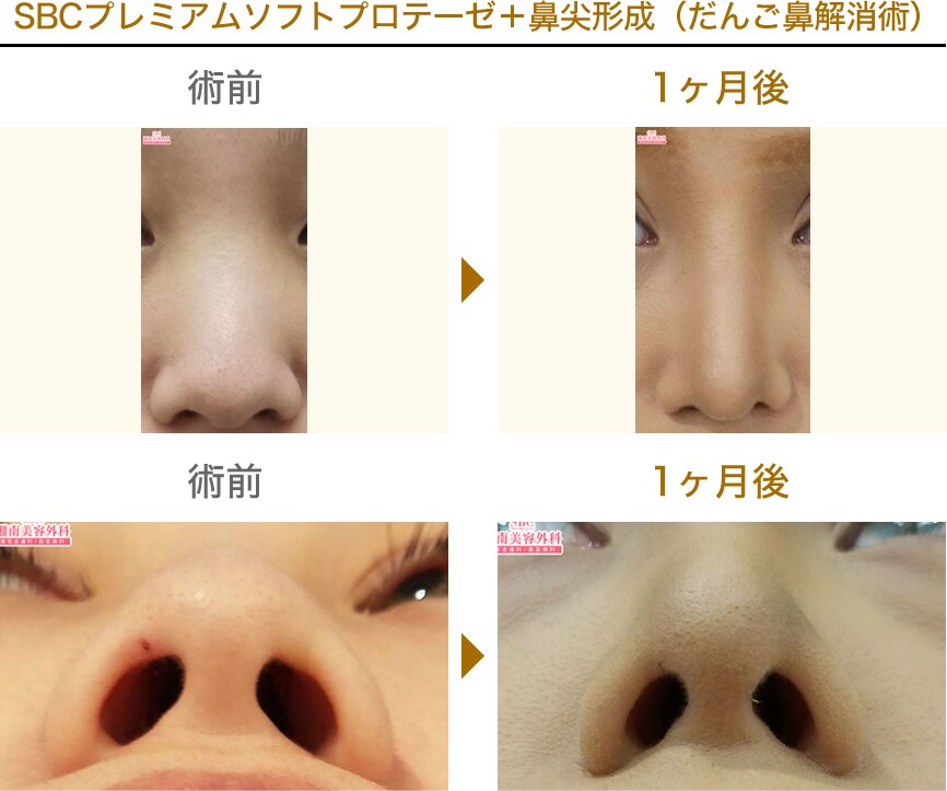 日米ダブルライセンス保持江連drプロデュ 鼻整形モニター募集 美容整形 美容外科の湘南美容クリニック 日米ダブルライセンス保持江連drプロデュ 鼻整形モニター募集 美容整形 美容外科の湘南美容クリニック