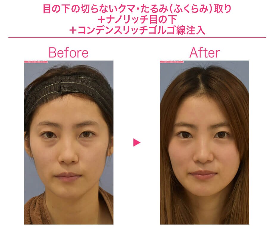 before after