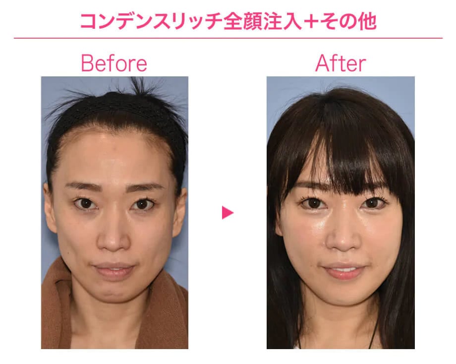 before after