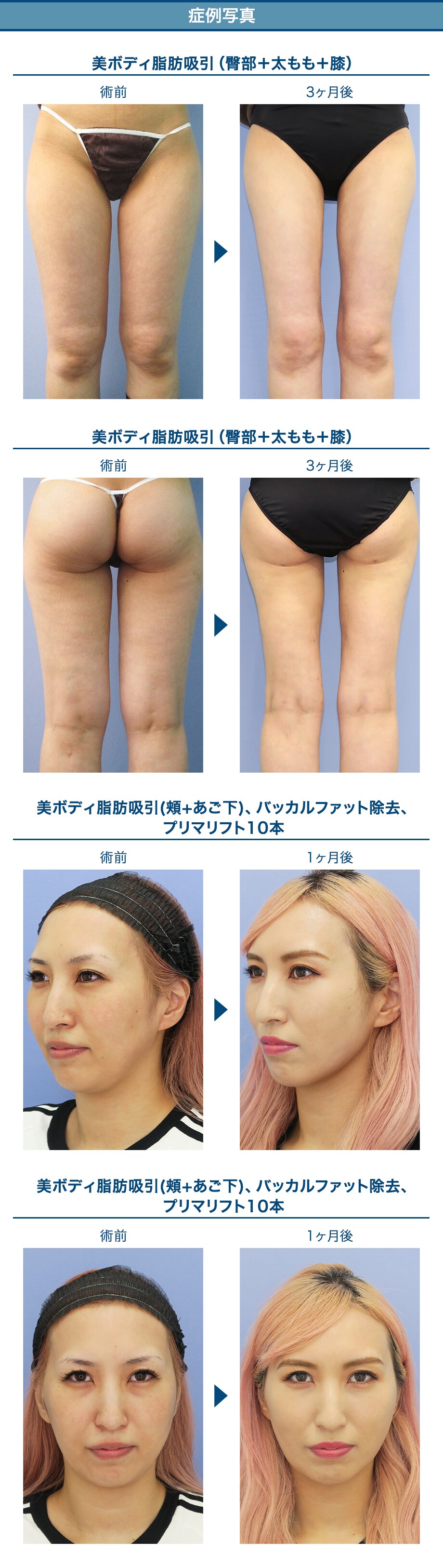 脂肪吸引 Face Body 脂肪吸引モニター募集 美容整形 美容外科の湘南美容クリニック