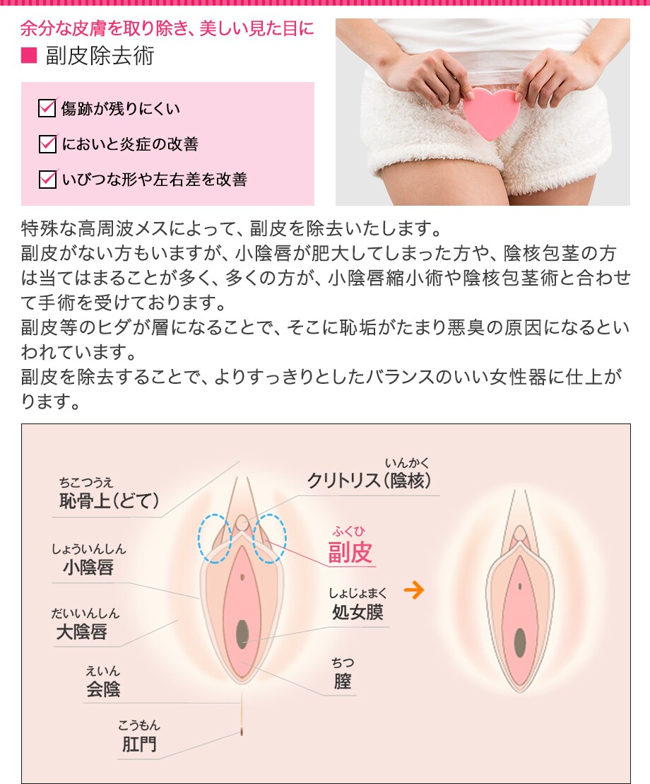 小陰唇縮小術 副皮除去術のモニター募集 湘南美容クリニック西葛西院院長 佐藤祥恵のブログ