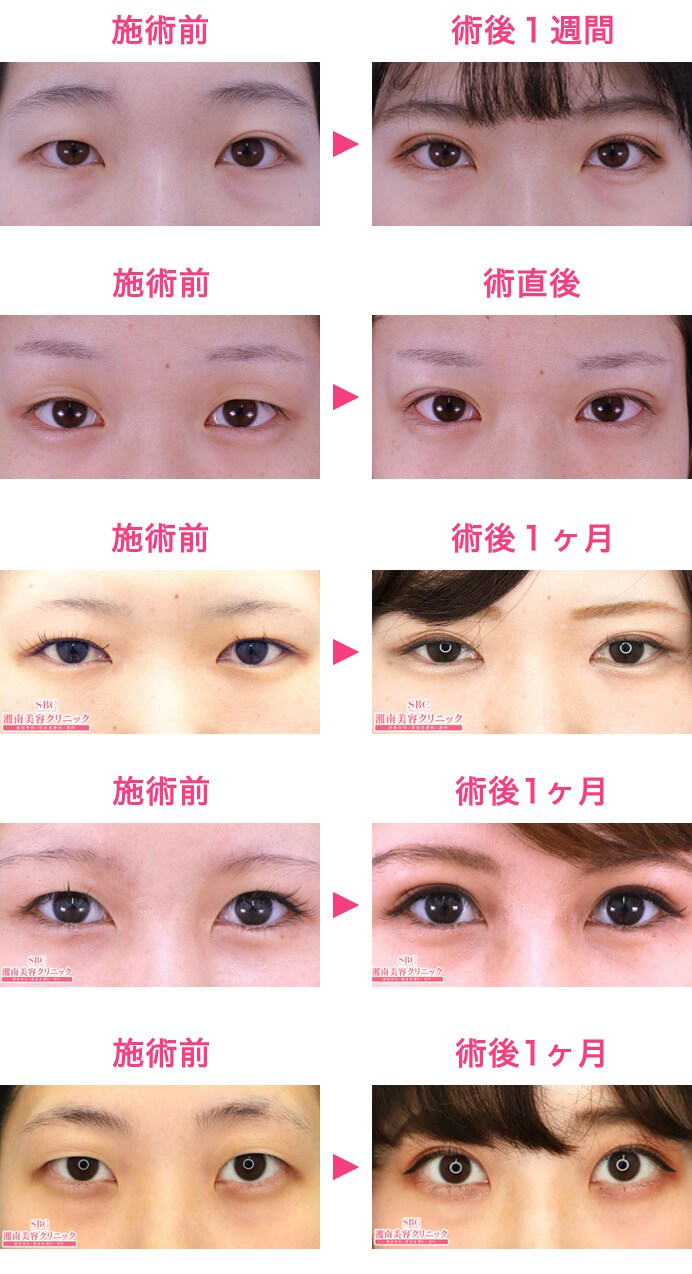 満足度オール5 連発 Best S 二重 二重整形モニター募集 美容整形 美容外科の湘南美容クリニック
