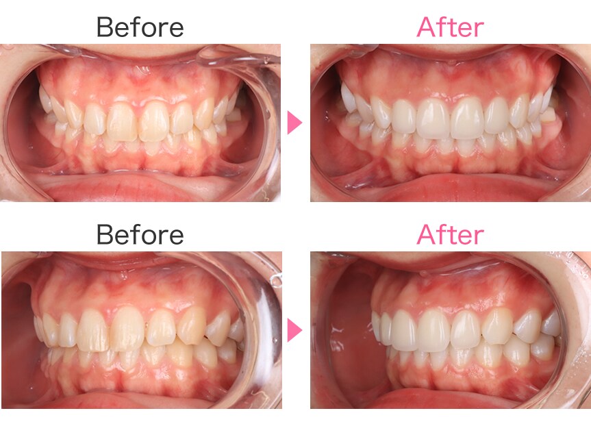 オールセラミックが4本でこの価格 名 美容歯科モニター募集 美容整形 美容外科の湘南美容クリニック