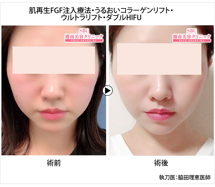 従来の美容針を超える たった30分で驚き 美容皮膚科モニター募集 美容整形 美容外科の湘南美容クリニック