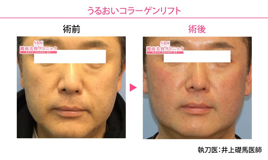 従来の美容針を超える たった30分で驚き 美容皮膚科モニター募集 美容整形 美容外科の湘南美容クリニック