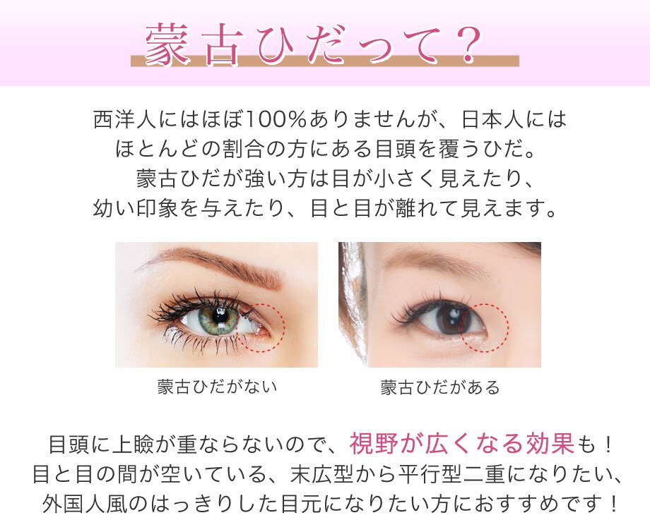 中国整形二重術 名古屋市金山 ワンホン 二重 二重整形モニター募集 美容整形 美容外科の湘南美容クリニック