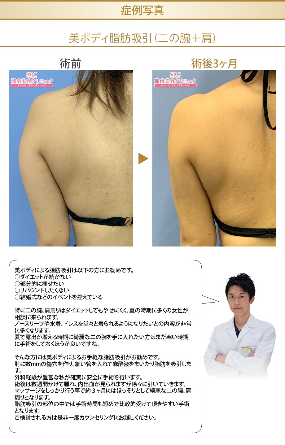 まだ間に合う夏がくる前に脂肪吸引 外科 脂肪吸引モニター募集 美容整形 美容外科の湘南美容クリニック