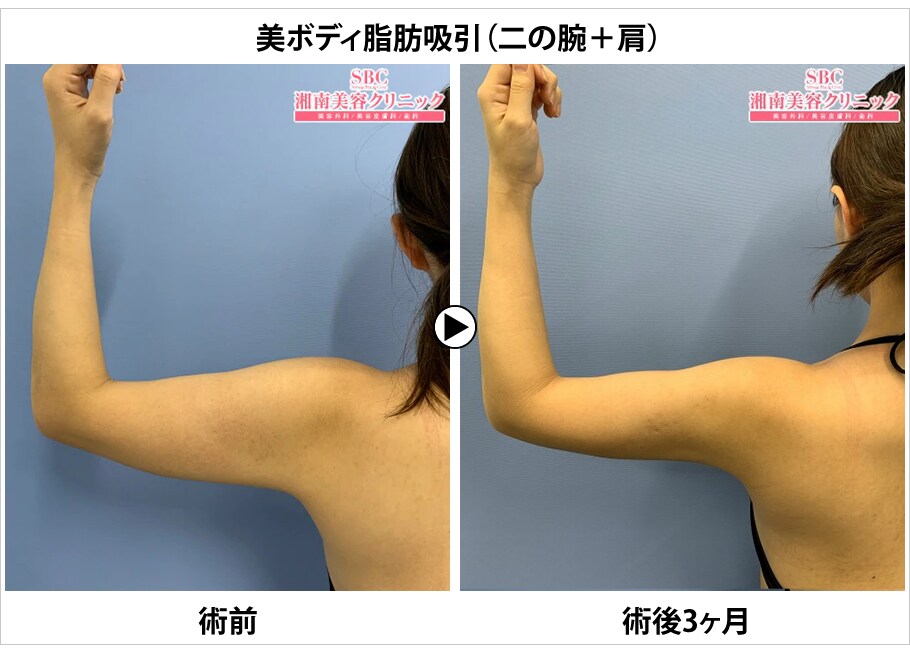 まだ間に合う夏がくる前に脂肪吸引 外科 脂肪吸引モニター募集 美容整形 美容外科の湘南美容クリニック まだ間に合う夏がくる前に脂肪吸引 外科 脂肪吸引モニター募集 美容整形 美容外科の湘南美容クリニック